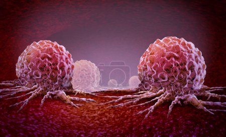 Cancer oncology and Malignant Cancerous Growth and Metastasis anatomy concept as growing tumor cells and Malignancy disease spreading metastasized on an organ inside the human body as a 3D illustration.