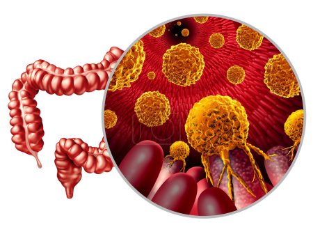 Colon cancer growth or colorectal malignant tumor concept as a medical illustration of a large intestine with a Metastatic Carcinogenic disease of the digestive system as a 3D illustration.