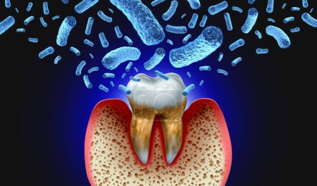 Bacterial tooth infection and teeth decay disease as an unhealthy molar with periodontitis due to poor oral hygiene health as an infectious bacteria concept with inflammation as a 3D illustration