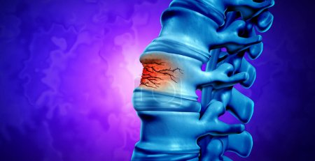 Fracture de la colonne vertébrale traumatique et lésion vertébrale concept médical comme une anatomie humaine colonne vertébrale avec une vertèbre éclatée cassée due à la compression ou à d'autres maladies du dos ostéoporose comme illustration 3D.