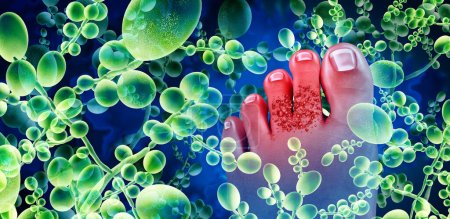 Fußpilzinfektion und Fußpilz oder Pilzkontamination als dermatologisches oder podologisches medizinisches Konzept mit 3D-Illustrationselementen.