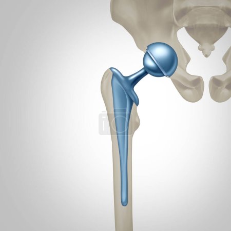 Hip Replacement Surgery concept as an artificial joint or prosthesis with orthopedic surgery inserting a metal ball and socket to replace a damaged by disease Femure joint in a 3D illustration style.