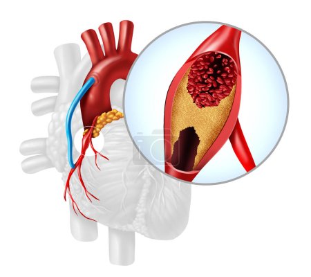 Heart Artery Bypass Grafting or CABG as an obstruction of plaque in the coronary artery or arteries as a vein from a leg that is grafted to a heart bypassing a blood circulation blockage in a 3D illustration style.