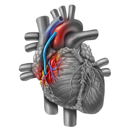 Koronare Arterienbypass-Transplantation oder CABG als Verstopfung von Plaque in der Herzkranzgefäßarterie oder Arterien als Vene von einem Bein, das zu einem Herzen verpflanzt wird, das einen Kreislaufstillstand in 3D-Darstellung umgeht.