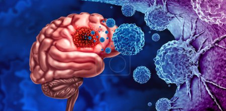 Cáncer de glioma El tumor como brote de células malignas como una enfermedad cerebral que ataca a las neuronas como concepto médico de enfermedad neurológica con elementos de ilustración 3D
