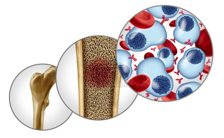 Multiple Myeloma concept and plasma cell cancer as a cancerous growth inside the bone marrow with 3D illustration elements.