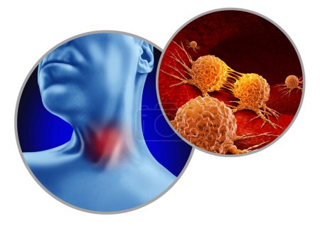 Cáncer de garganta como crecimiento celular anormal como cánceres aríngeos o faríngeos y relacionados con el VPH como paciente con un tumor en el cuello con elementos de ilustración 3D.