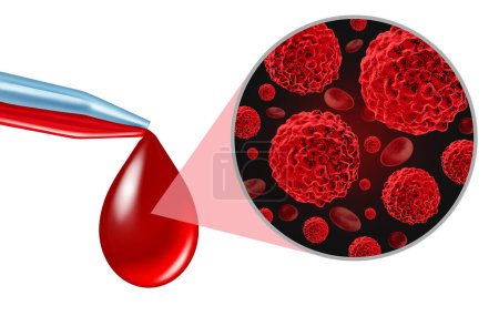 Blutkrebs-Screening-Test als onkologische medizinische Diagnose auf Tumormarker als flüssige Biopsie zur Früherkennung bösartiger Zellen zur Diagnose von Eierstock- und Prostatakrebs.