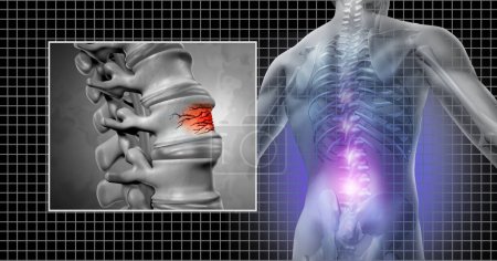 Wirbelsäulenfraktur und Rückenschmerzen als Wirbelsäulenverletzung und Wirbeltrauma als osteopathisches medizinisches Konzept.