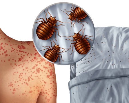Bedbug bites rash or bedbug infestation concept as a magnification close up of  parasitic insect pests as a hygiene symbol and health danger of bloodsucking parasites with 3D illustration style.
