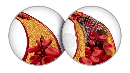 Stents in Angioplastik und Stent medizinisches Implantatkonzept Behandlungssymbol als chirurgischer Eingriff in einer Arterie, deren Cholesterinablagerung für erhöhten Blutfluss geöffnet wird.