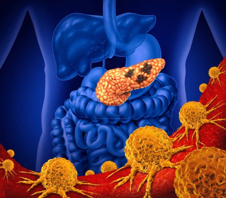 Bauchspeicheldrüsenkrebs-Konzept und bösartiger Tumor der Bauchspeicheldrüse als Verdauungsdrüsenkörperteil im menschlichen Körper.