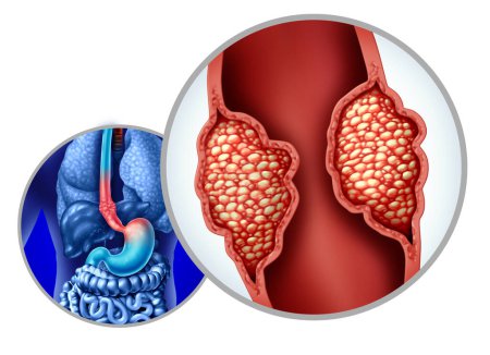 Cáncer de esófago o carcinoma de esófago como adenocarcinoma crecimiento celular mutante dentro del sistema digestivo como tumor en crecimiento de cerca.