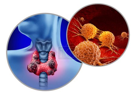 Schilddrüsenkrebs Symptome des Rachendrüsenkonzepts als menschliches Organ mit bösartigem Tumorwachstum mit wachsenden Zellen als Symbol für Erkrankungen des endokrinologischen Systems.