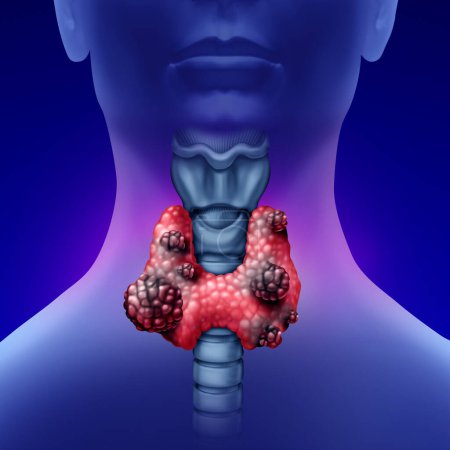 Schilddrüsenkrebs als menschliches Organ mit bösartigem Tumorwachstum als Symbol für Erkrankungen des endokrinologischen Systems.