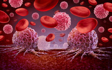 Leukemia and Cancer in the blood outbreak and treatment for malignant cells in a human body caused by carcinogens and genetics with a cancerous cell as an immunotherapy or lymphoma symbol and oncology therapy.