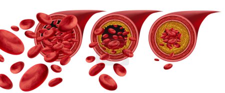 Atherosklerose Plaque Bildung und Verstopfte Arterien Krankheit medizinisches Konzept mit Blutzellen, die durch Cholesterinanreicherung blockiert wird als Symbol für arteriosklerotische Gefäßerkrankungen.