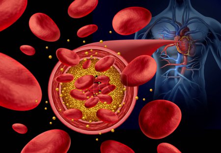 Atherosklerose Arterienbelag und Verstopfte Arterien Krankheit medizinisches Konzept mit Blutzellen, die durch die Anhäufung von Cholesterin als Symbol für arteriosklerotische Gefäßerkrankungen blockiert ist.