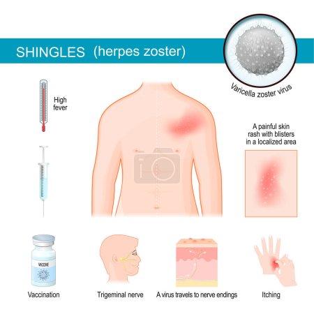 Shingles. infographics about Signs and symptoms of herpes zoster. Human torso with itching rash. Close-up of Varicella zoster virus. The virus travels to nerve endings in the skin, producing blisters. Trigeminal nerve