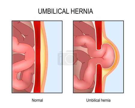 Umbilical hernia. Cross section of abdomen with small intestine, muscle and abdominal wall. Normal human's belly and muscle rupture with hernial sac. Vector poster