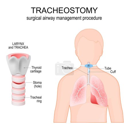 Traqueostomía. Procedimiento quirúrgico de manejo de la vía aérea. Anatomía de la tráquea con estoma. laringe. silueta humana con pulmones, tráquea, bronquios. colocación correcta de un tubo de traqueostomía en la tráquea. ilustración vectorial