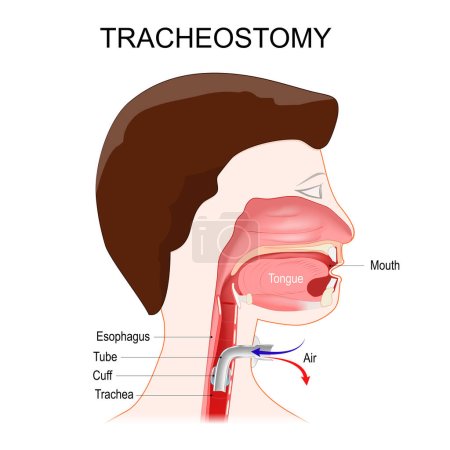 Illustration for Tracheotomy. side view of the neck and the correct placement of a tracheostomy tube in the trachea. The stoma for a tracheal tube or tracheostomy tube. Vector illustration - Royalty Free Image
