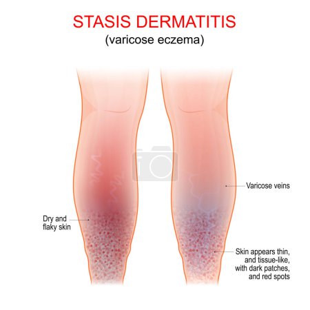 Illustration for Varicose eczema. Symptoms of venous, gravitational or stasis dermatitis. long-term skin condition that affects the lower legs with varicose veins. Vector poster - Royalty Free Image