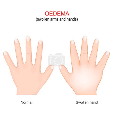 Edema. Brazos y manos hinchados. edema es la acumulación de líquido en el tejido del cuerpo. Ilustración vectorial. Póster para uso médico
