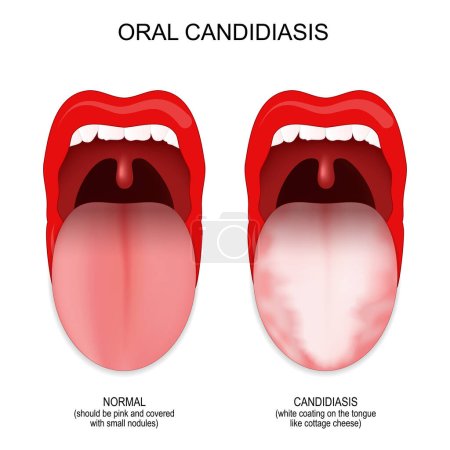 Mündliche Kandidatur. Unterschied und Vergleich von gesundem Mund und Zunge mit Pilzinfektionen. Vektorplakat