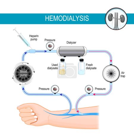 Das Prinzip der Hämodialysemaschine. Dialyseprozess. Die Hämodialyse leitet das Blut in eine externe Maschine um, wo es vorher gefiltert und wieder in das Blutgefäß zurückgeführt wird. Vektorillustration