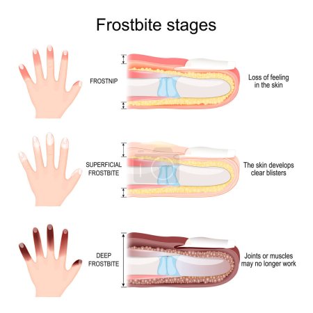 Stades de gelure des doigts. Du Frostnip avec perte de sensation dans la peau au Frostbite profonde des articulations et des muscles. Illustration vectorielle