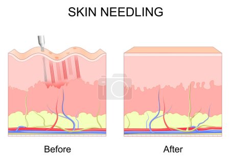 Mikroneedling. Hautnadeln. Vor und nach kosmetischen Eingriffen. Querschnitt durch Schichten menschlicher Haut mit Falten. Nahaufnahme des Dermarolling-Prozesses. Kollageninduktionstherapie. Vektorplakat