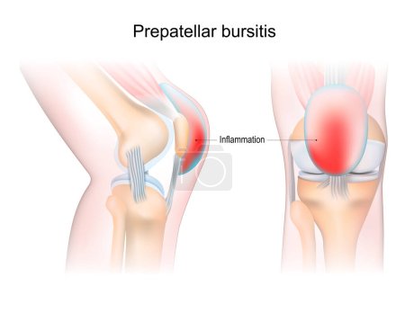 Illustration for Bursitis. Prepatellar bursitis. inflammation of sacs with synovial fluid. Front and side view of human knee joint. Lateral and anterior section of the knee. vector illustration. - Royalty Free Image