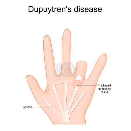 Morbus Dupuytren. Menschliche Hand mit Sehnen und verdicktem Bindegewebe unter einem Finger. Vektorillustration