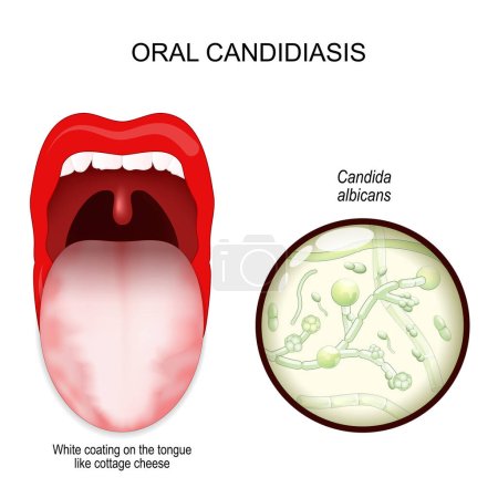Illustration for Oral candidiasis. oral thrush yeast infection. White coating on the tongue like cottage cheese. Close-up of a fungi Candida albicans. Vector illustration - Royalty Free Image
