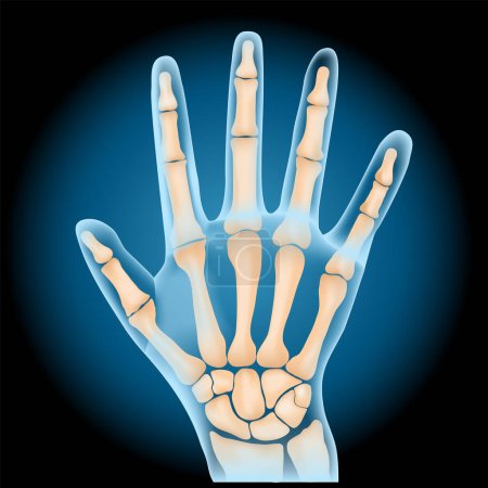 Illustration for Carpal bones. Human hand anatomy. small bones of the wrist: Scaphoid, Lunate, Triquetrum, Pisiform, Trapezium, Trapezoid, Capitate and Hamate. x-ray blue realistic palm on dark background. Vector poster - Royalty Free Image