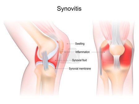 Illustration for Synovitis of a Knee. Close-up of joint with inflammation of the synovial membrane. Signs and symptoms of the disease. Synovial joint anatomy. Frontal and side view of human knee joint. Vector illustration - Royalty Free Image