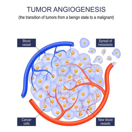 Angiogenèse tumorale. transition des tumeurs d'un état bénin à un état malin. tumeur grandir. Cellules cancéreuses et propagation des métastases. Affiche vectorielle