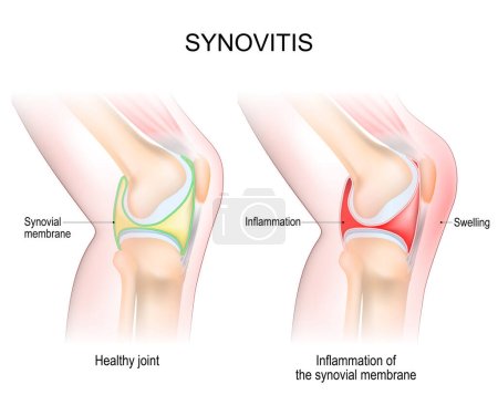 Illustration for Synovitis of a Knee. Close-up of normal joint, and knee with inflammation of the synovial membrane. Signs and symptoms of the disease. side view of human knee joint. Vector illustration - Royalty Free Image
