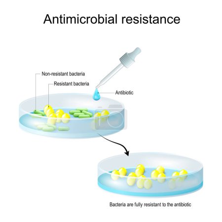 Antimikrobielle Resistenz. Nicht resistente und resistente Bakterien. Bakterienkolonien vor und nach der Antibiotikatherapie. Pipette mit Antibiotikatropfen und Petrischale mit Bakterienkolonie. Experiment der Biotechnologie oder Mikrobiologie