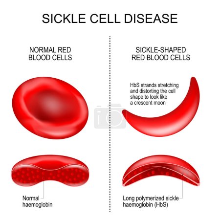 Illustration for Sickle cell disease. difference and comparison between Normal red blood cell and Sickle-shaped erythrocytes. HbS strands stretching and distorting the cell shape to look like a crescent moon. Normal haemoglobin of a healthy person, and Long polymeriz - Royalty Free Image