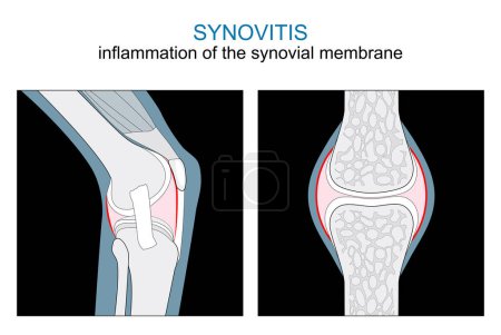 Illustration for Types of Synovitis. inflammation of the synovial membrane of a Knee and Synovial joint. monochrome flat vector like x-ray illustration. - Royalty Free Image
