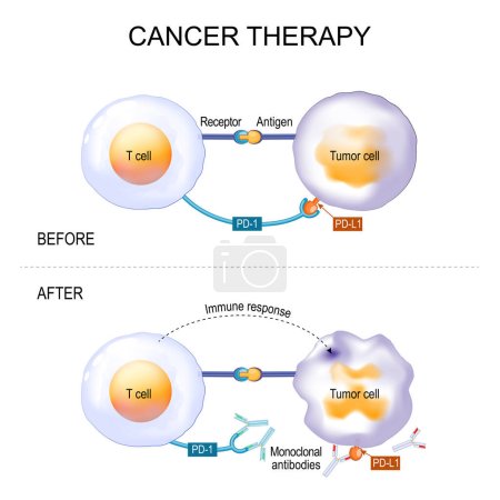 Krebstherapie monoklonaler Antikörper. Behandlung von Gebärmutterhalskrebs, Hodgkin-Lymphom, Karzinom, Brust- und Lungentumor. Antikörper binden an den PD-1-Rezeptor und blockieren seine Aktivität, die verhindert, dass Tumorzellen die Immunantwort umgehen. Vektor 