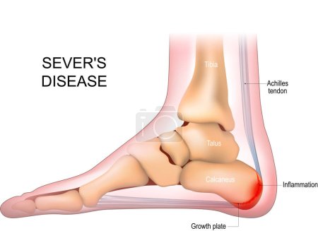 Severs disease. calcaneus apophysitis. inflammation at the back of the heel growth plate. Foot anatomy. side view of a Human foot with the name of bones. Arches of the feet. skeleton anatomy. realistic Vector poster