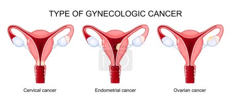 Type of gynecologic cancer. Ovarian, Endometrial, and Cervical cancer. diagram shows cross section of uterus with different parts of a woman reproductive system. Malignant tumors. vector poster
