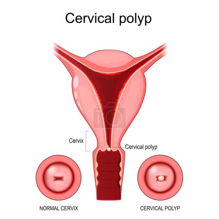 Illustration for Cervical polyp. Cross section of a Human uterus. Normal cervix and benign tumor on the surface of the cervical canal. Vector illustration - Royalty Free Image