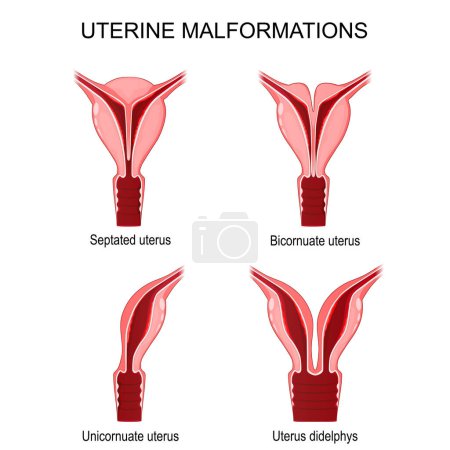 Ilustración de Malformaciones uterinas. Unicornio, didelfos, bicornio y útero septido. Cartel vectorial para uso médico - Imagen libre de derechos