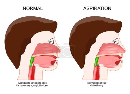 Illustration for Dysphagia or aspiration. medical diagnosis. Cross section of a human head. Healthy person when a soft palate elevated to close the nasopharynx, epiglottis closes. Unhealthy people have difficulty in swallowing, and the inhalation of fluid while drink - Royalty Free Image