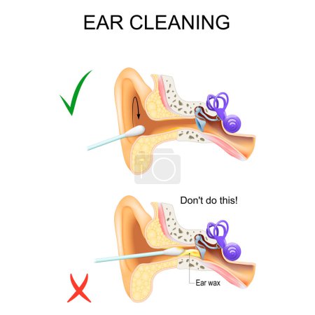 Ilustración de Ear Cleaning with a cotton swab. Earwax Removal. Cross section of human's ear. Vector poster - Imagen libre de derechos
