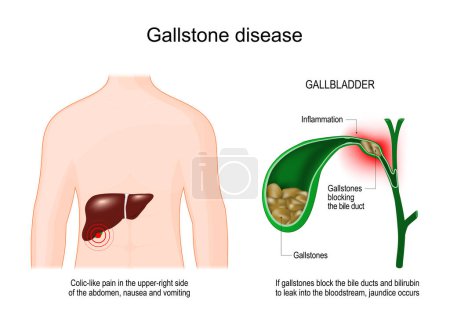 Téléchargez les illustrations : Gallstone disease. Human body with liver. Cross section of Gallbladder with Gallstones that blocking of a bile duct. Symptoms of cholelithiasis. Colic-like pain in the upper-right side of the abdomen when bilirubin to leak into the bloodstream, jaund - en licence libre de droit
